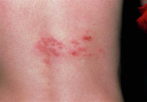 When the symptoms begin to subside, the ulcers form scabs, which then. . Herpes rash pictures female
